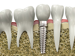Dental Implants in Green Bay